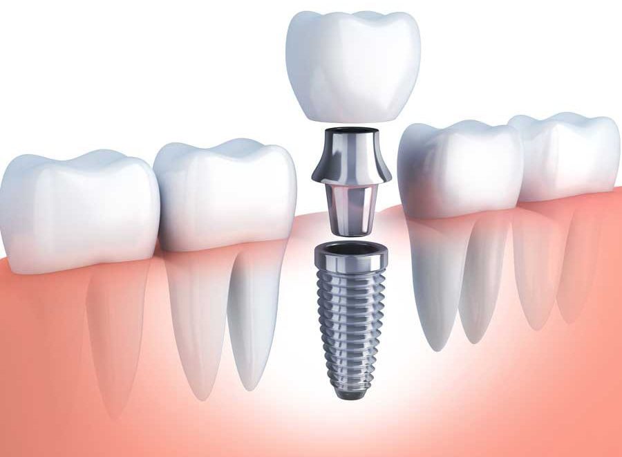 dental implant e1685268223488