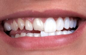 Before and after dental veneers