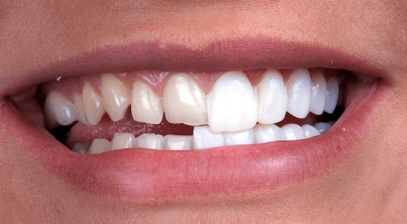 Before and after dental veneers